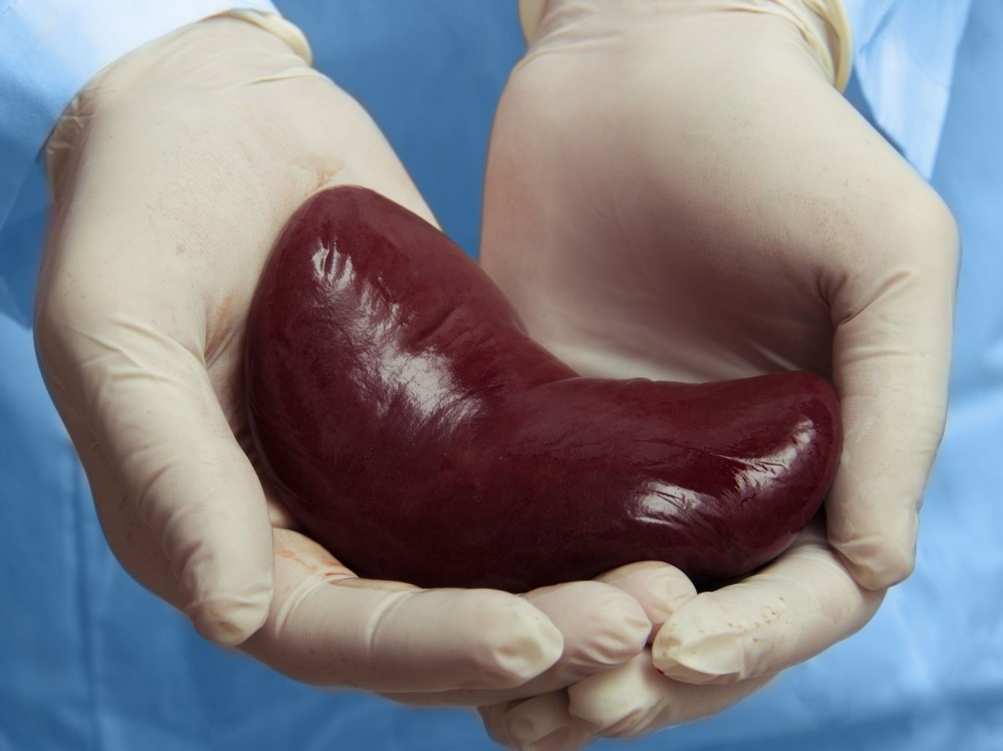 kidney_transplant